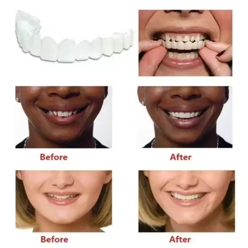 Okładziny na zęby Wybielanie z – Teeth Whitening Veneers recenzja i cena
