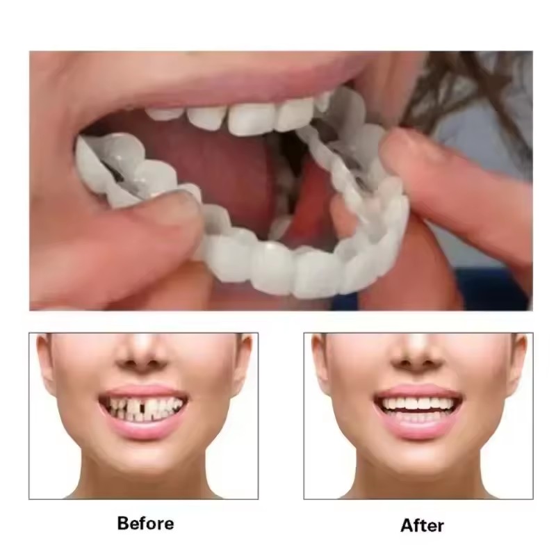 Okładziny na zęby Wybielanie z – Teeth Whitening Veneers recenzja i cena