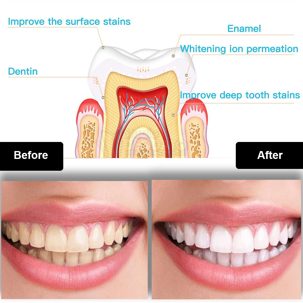 Zestaw do wybielania zębów den – Teeth Whitening Pens recenzja i cena